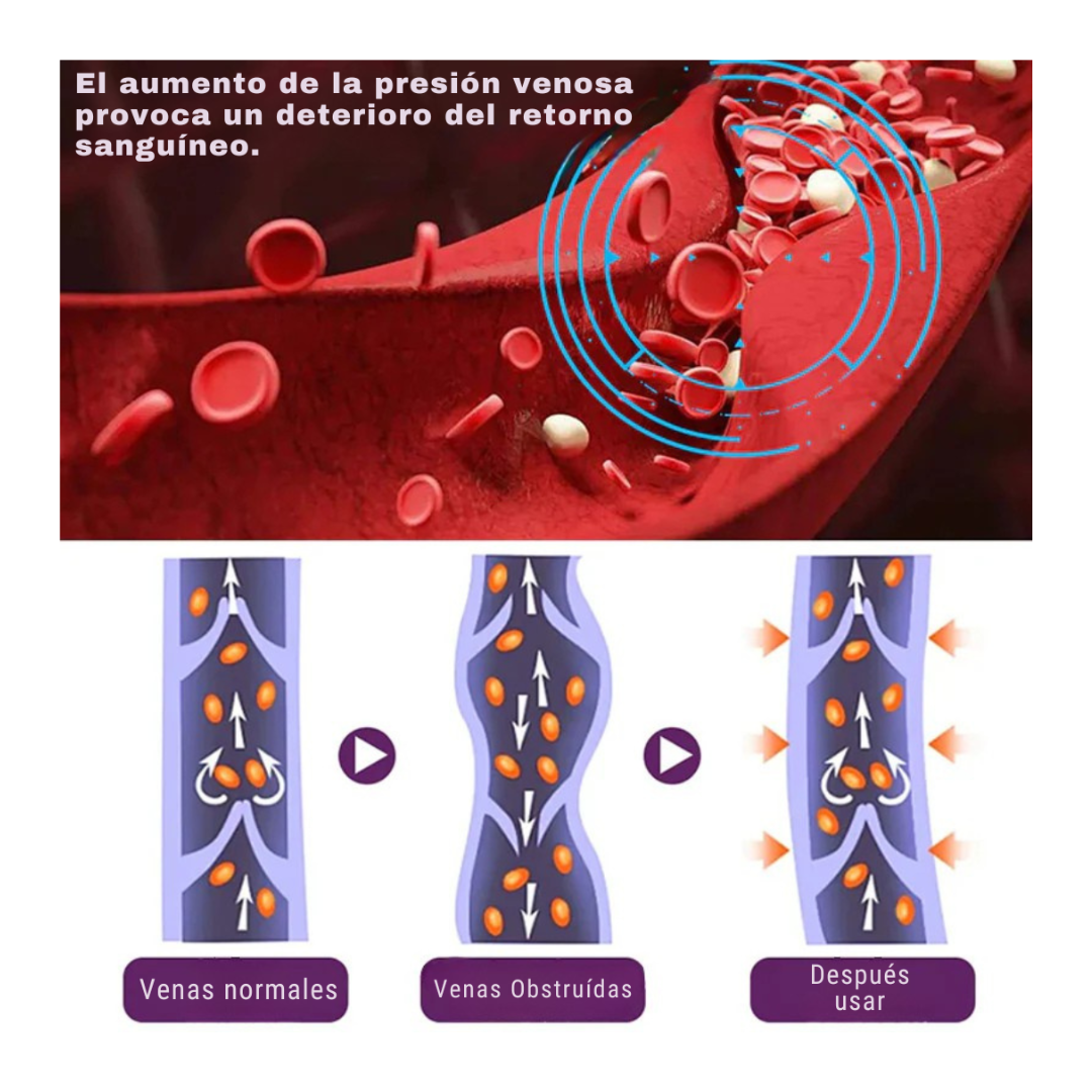 TRATAMIENTO PARA ELIMINAR VARICES Y DOLOR ANTIVARICE PRO®