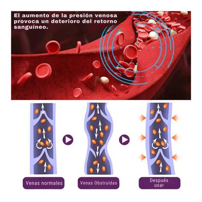 TRATAMIENTO PARA ELIMINAR VARICES Y DOLOR ANTIVARICE PRO®